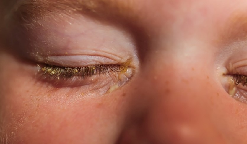Cơ chế lây lan đau mắt đỏ và cách phòng tránh