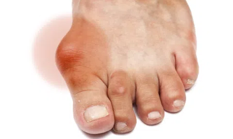 Những thảo dược có lợi cho người mắc bệnh gout