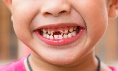 Xịt chống sâu răng trẻ em - Sản phẩm mới giúp bảo vệ sức khỏe răng miệng cho trẻ nhỏ