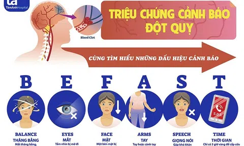 Kiến thức thường thức về đột quỵ