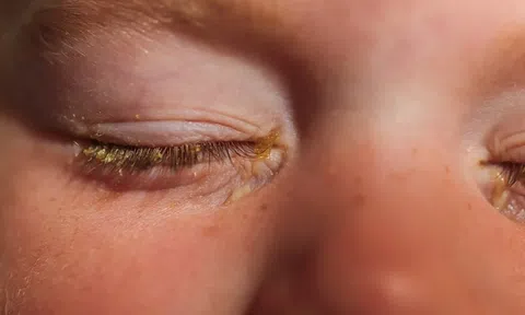 Cơ chế lây lan đau mắt đỏ và cách phòng tránh